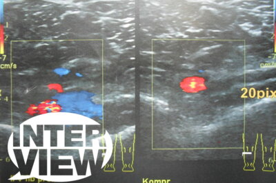 Radsport und Thrombose: Wie erkennen  – und darf man weiter trainieren?